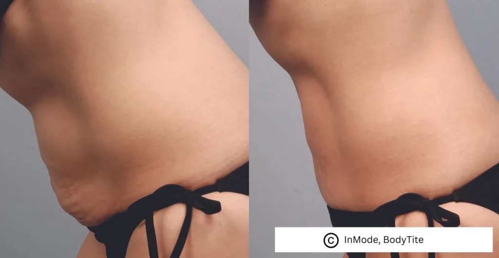 Vorher-Nachher-Bilder einer BodyTite™ Behandlung.