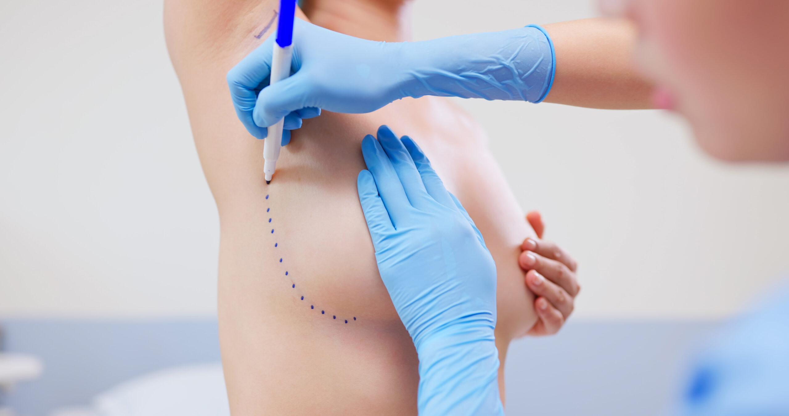 Einschnitt wird vorgezeichnet bei einer OP zum Implantatwechsel