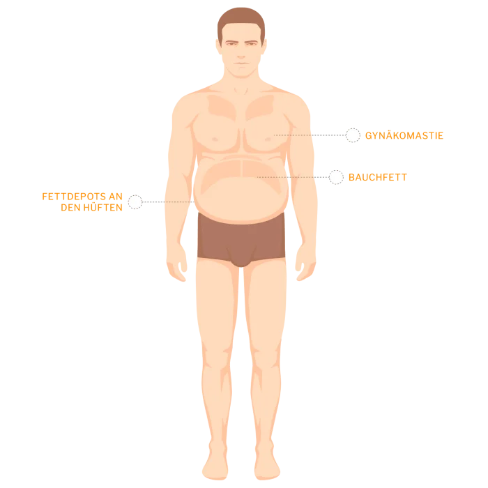 Illustration mit Bereichen für eine Liposuktion beim Mann