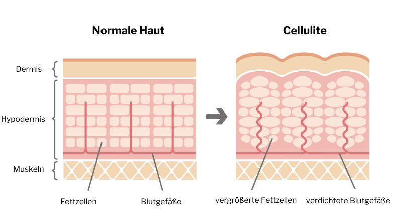 Normale-Haut-vs.-Cellulite